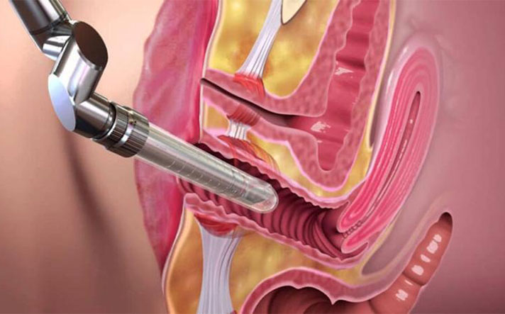 Vaginal Laxity