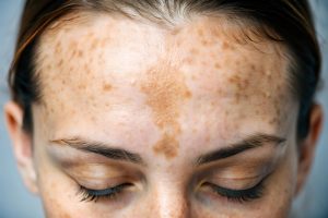 Hyperpigmentation treatment in kharghar